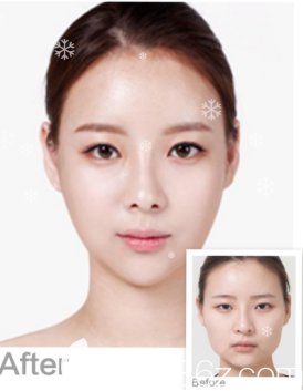 威海威高梨花醫(yī)療美容醫(yī)院雙眼皮+吸脂案例