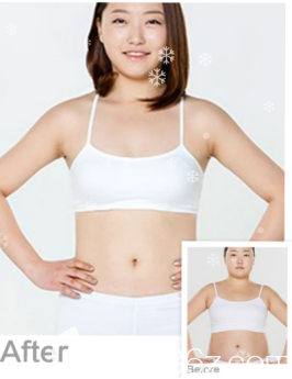 威海威高梨花醫(yī)療美容醫(yī)院全身吸脂案例