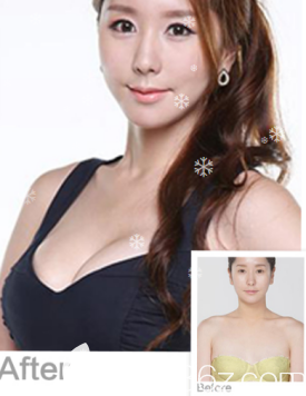 威海威高梨花醫(yī)療美容醫(yī)院假體隆胸案例