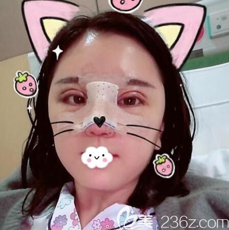 眼綜合鼻綜合術(shù)后即刻 眼綜合鼻綜合術(shù)后即刻