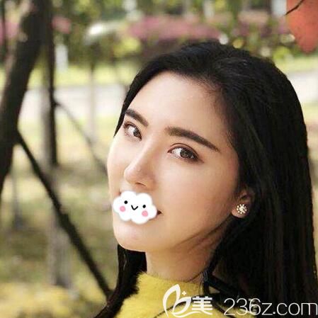 楊建雙眼皮隆鼻術(shù)后半年美照 楊建雙眼皮隆鼻術(shù)后半年美照