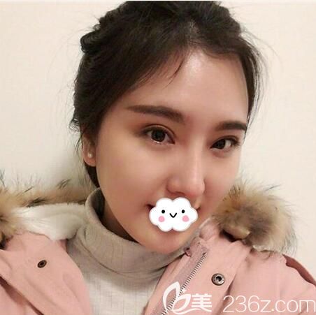 全切雙眼皮術(shù)后3個月效果 全切雙眼皮術(shù)后3個月效果