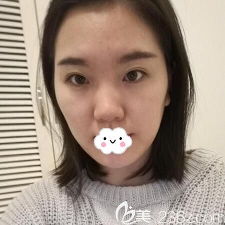 手術(shù)前雙眼一內(nèi)雙一雙不對稱 手術(shù)前雙眼一內(nèi)雙一雙不對稱