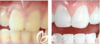 醫(yī)院整形美容科李育林冷光牙齒美白 醫(yī)院整形美容科李育林冷光牙齒美白