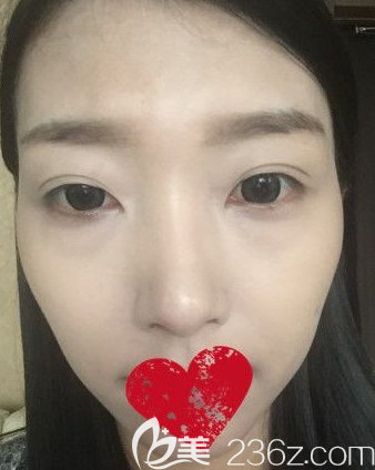 沈明自體脂肪填充面部術(shù)前照片