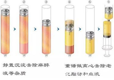 自體脂肪優(yōu)化分離圖