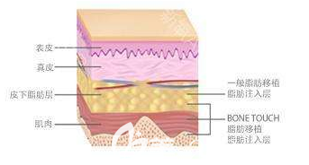 自體脂肪作用在皮膚的部位示意圖