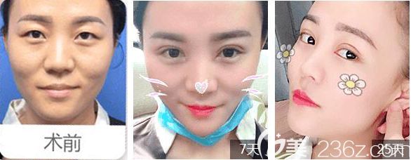 常州美貝爾雙眼皮<span style=