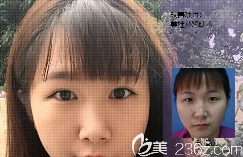 王主任做埋線雙眼皮的手術(shù)案例