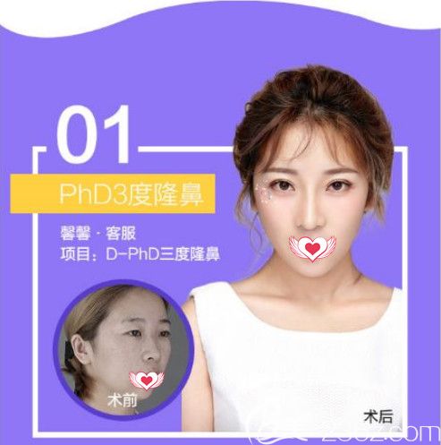 蔡鵬武院長做鼻綜合案例 蔡鵬武院長做鼻綜合案例