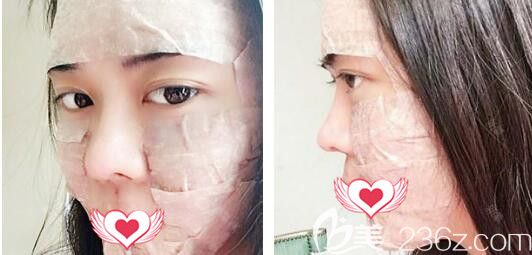 蕪湖壹加壹怎么樣？看王心音全臉填充自體脂肪后即刻照