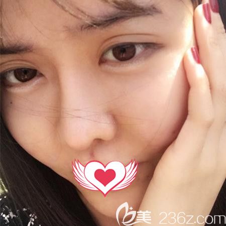 壹加壹整形自體脂肪填充全臉術(shù)后第9天恢復(fù)情況