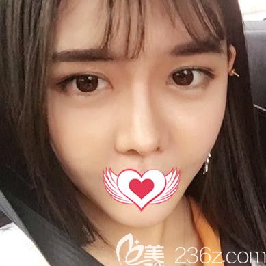 蕪湖壹加壹和伊萊美哪個(gè)好？看壹加壹自體脂肪面部填充術(shù)后31天圖