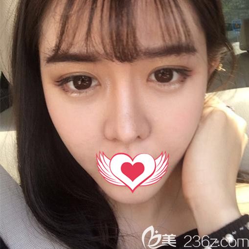 屬于蕪湖壹加壹脂肪填充術(shù)后第90天效果圖