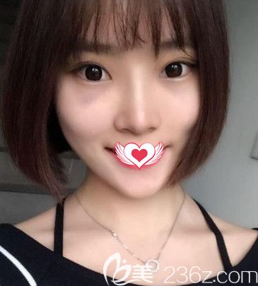 韋杰醫(yī)生為我做假體隆鼻術(shù)后16天鼻子消腫