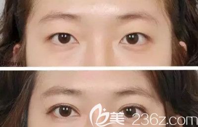 做雙眼皮案例