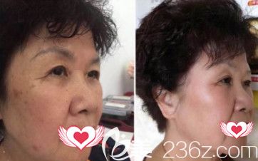 邯鄲都市激光祛斑案例