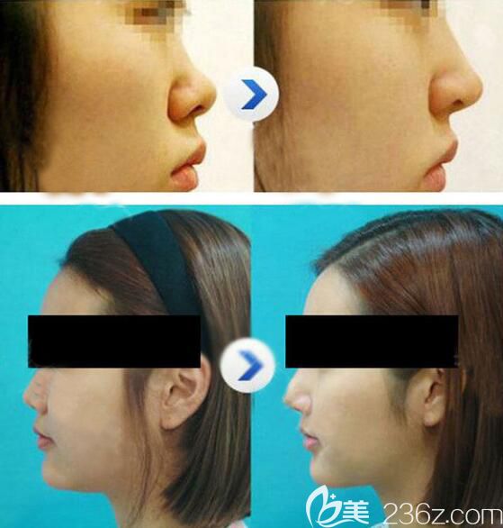 無錫施爾美小翹鼻對比效果