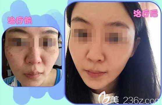 無錫施爾美祛斑效果