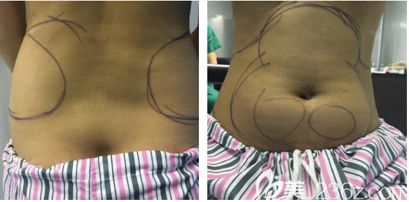 深圳南雅抽脂案例術(shù)前照片 深圳南雅抽脂案例術(shù)前照片