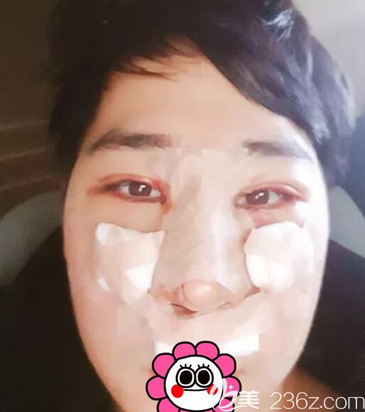 在韓國(guó)BK整形找李丙濬院長(zhǎng)做眼鼻整形術(shù)后 在韓國(guó)BK整形找李丙濬院長(zhǎng)做眼鼻整形術(shù)后