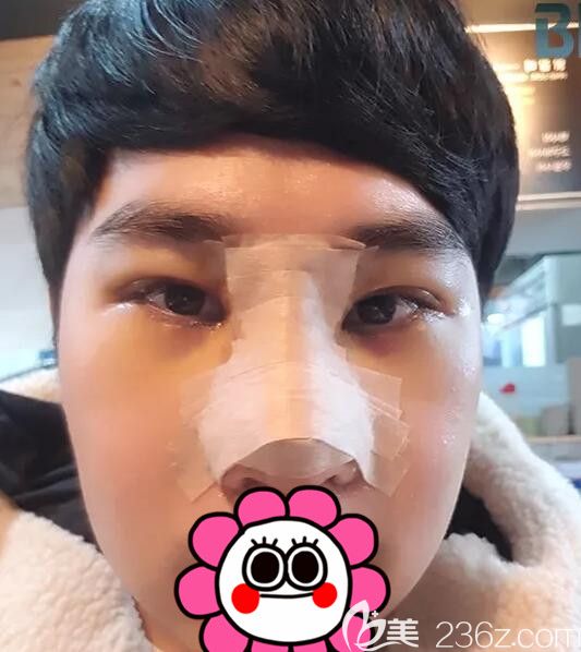 逐漸消腫的雙眼皮+鼻部整形 逐漸消腫的雙眼皮+鼻部整形