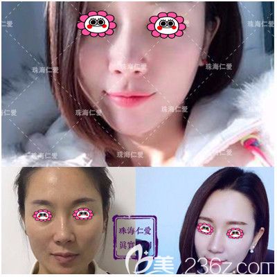 珠海仁愛瘦臉變化圖