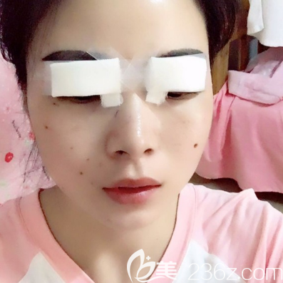 珠海仁愛雙眼皮案例術(shù)后天效果圖 珠海仁愛雙眼皮案例術(shù)后天效果圖