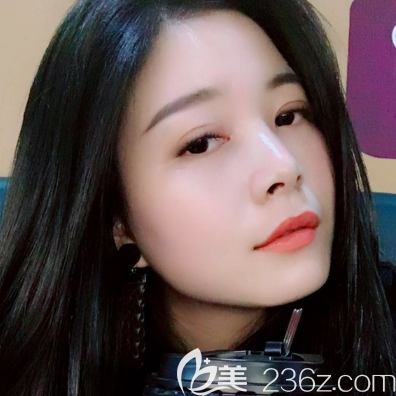 珠海仁愛肖新春醫(yī)生雙眼皮案例一個(gè)月自拍 珠海仁愛肖新春醫(yī)生雙眼皮案例一個(gè)月自拍