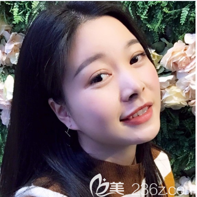 感覺自己單眼皮不好看于是去珠海仁愛找肖新春醫(yī)生做了全切雙眼皮手術(shù)