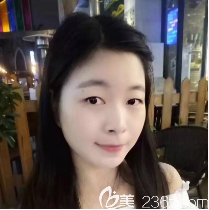 珠海仁愛雙眼皮案例術(shù)前照片 珠海仁愛雙眼皮案例術(shù)前照片