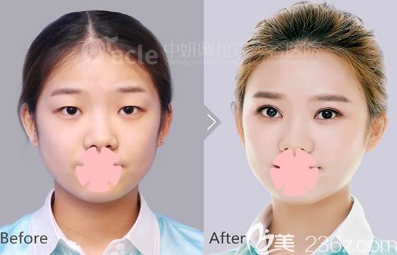 長(zhǎng)春奧拉克陳繼革院長(zhǎng)眼綜合+面部脂肪填充效果圖 長(zhǎng)春奧拉克陳繼革院長(zhǎng)眼綜合+面部脂肪填充效果圖