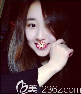 重慶藝星自體脂肪面部填充效果怎么樣