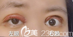 雙眼皮術(shù)后血腫和感染的圖片