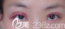 雙眼皮術(shù)后發(fā)炎的樣子