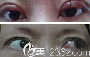 小白雙眼皮術(shù)后左眼不能閉合的樣子