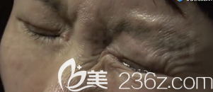 左眼強(qiáng)制閉合后的樣子