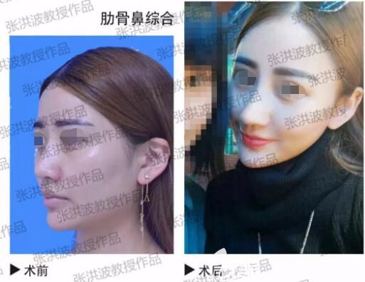 張洪波醫(yī)生隆鼻前后對比案例 張洪波醫(yī)生隆鼻前后對比案例