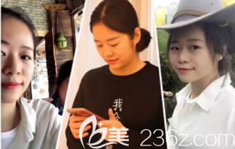 我在柳州華美整形做眼鼻部整形前的照片 我在柳州華美整形做眼鼻部整形前的照片