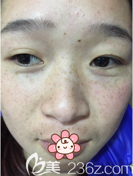 術(shù)前我的斑很多 術(shù)前我的斑很多