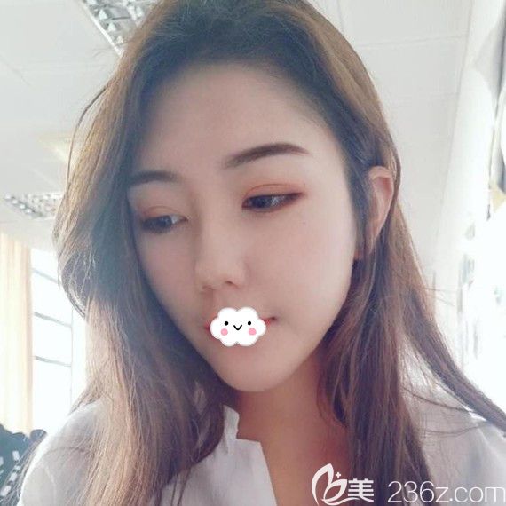 荊州華美李杰埋線雙眼皮2個(gè)月恢復(fù)圖