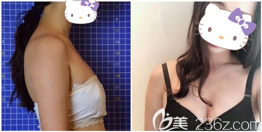 金輝院長做假體隆胸手術(shù)恢復(fù)效果 金輝院長做假體隆胸手術(shù)恢復(fù)效果