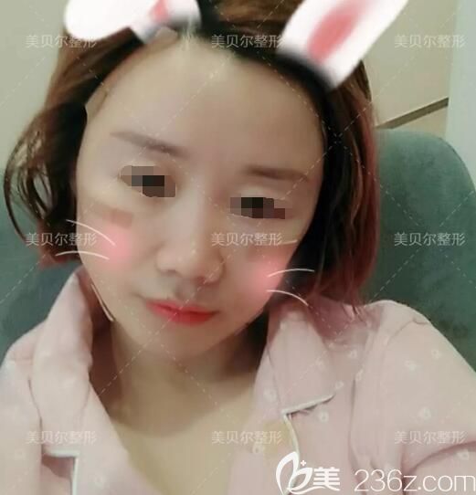 李志勇醫(yī)生做脂肪填充術(shù)后天 李志勇醫(yī)生做脂肪填充術(shù)后天