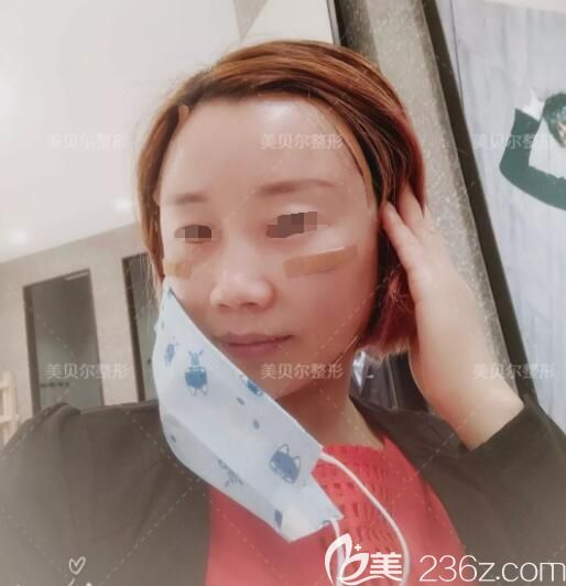 找蘇州美貝爾醫(yī)生做自體脂肪填充術(shù)后三天 找蘇州美貝爾醫(yī)生做自體脂肪填充術(shù)后三天