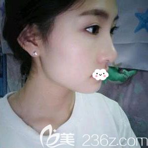 隨州奧萊隆鼻整形效果怎么樣?韓國進口三段式硅膠假體隆鼻術(shù)后恢復(fù)過程圖