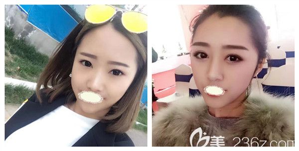 成都銅雀臺徐敦醫(yī)生全切雙眼皮+開內(nèi)眥贅皮術(shù)后對比照