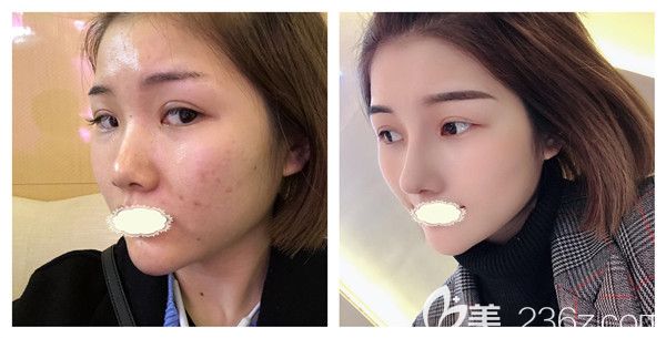 成都銅雀臺周柯醫(yī)生肋軟骨假體隆鼻真實案例