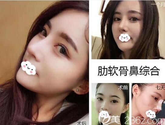 南充整鼻子多少錢？南充達芬奇整形美容醫(yī)院全新價格表隆鼻1880元起