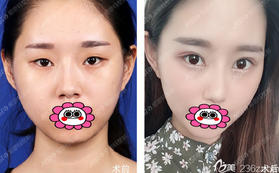 無錫愛思特春天歐陽黎平雙眼皮效果圖