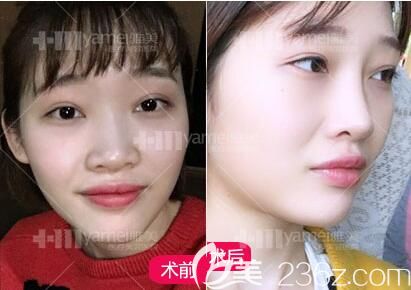 做鼻整形術(shù)前照 做鼻整形術(shù)前照